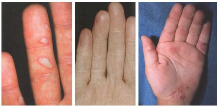 Obr. 6: Nemoc rukou, nohou a úst [4]; xantomatóza [6]; bulózní epidermolýza [7]